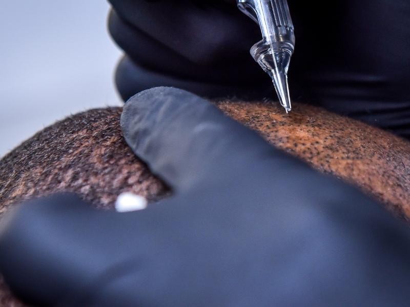 Micropigmentação Capilar