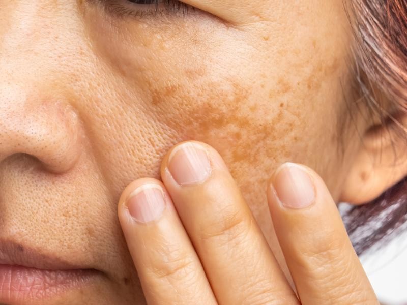 Tratamento para Manchas e Melasmas