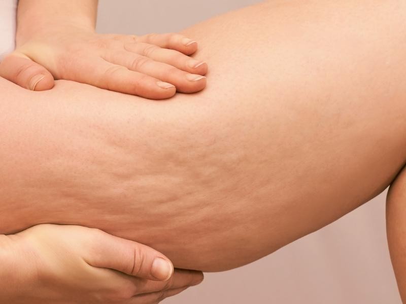 Tratamento de Celulite