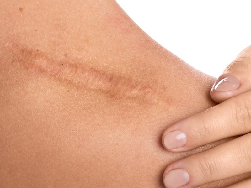 Tratamento de Cicatriz