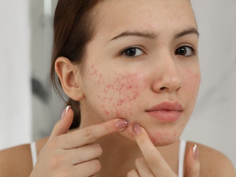 Tratamento de Acne