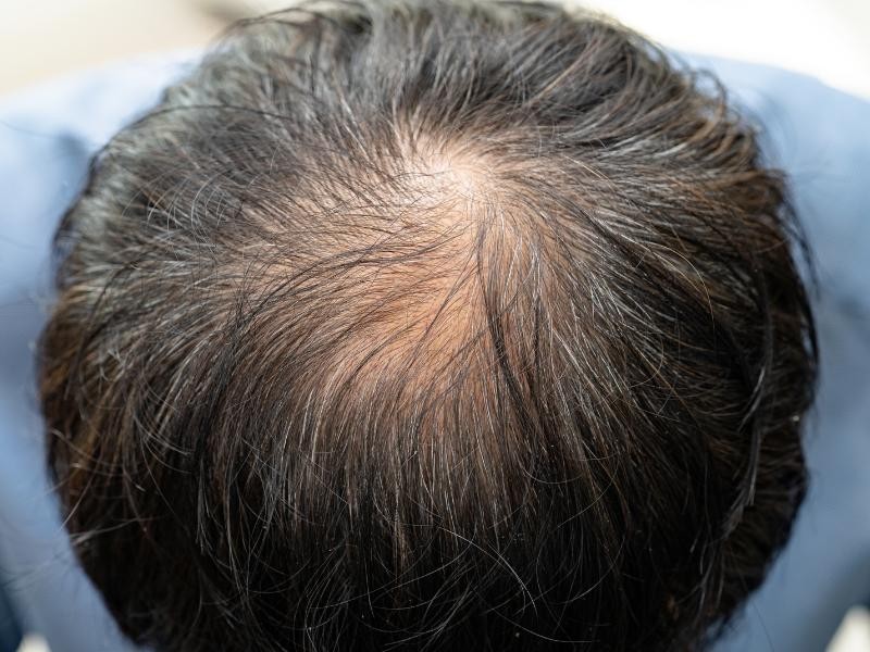 Tratamento para Calvície Masculina