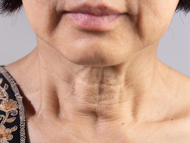 Tratamento para Flacidez Facial